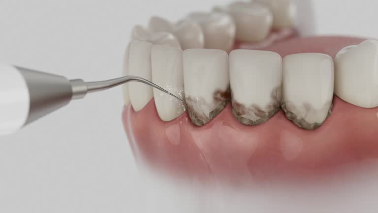 Reliable Dental Implants contractor in Brier, WA by Smile Center Dentistry